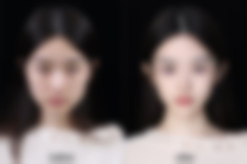 瘦脸针的作用好不好女性