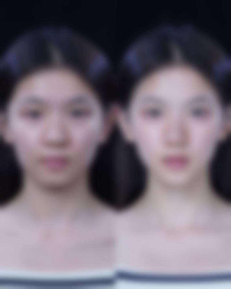 美白针可以打在脸上吗