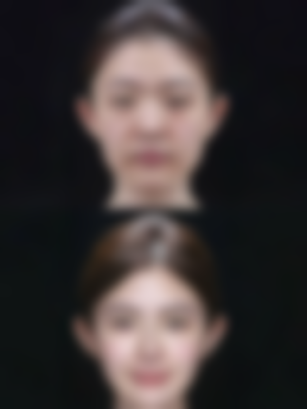 用什么方法能除皱？揭秘医美界3大热门除皱法，让你轻松告别皱纹，重焕青春光彩！ 