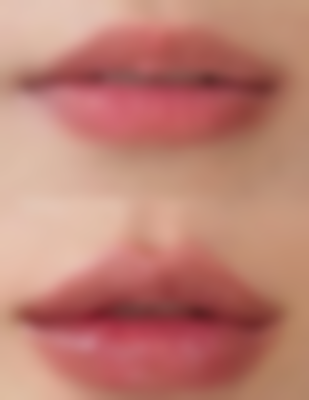 注射瘦脸针前和后的注意事项