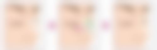 打瘦脸针注意事项以及以后保养