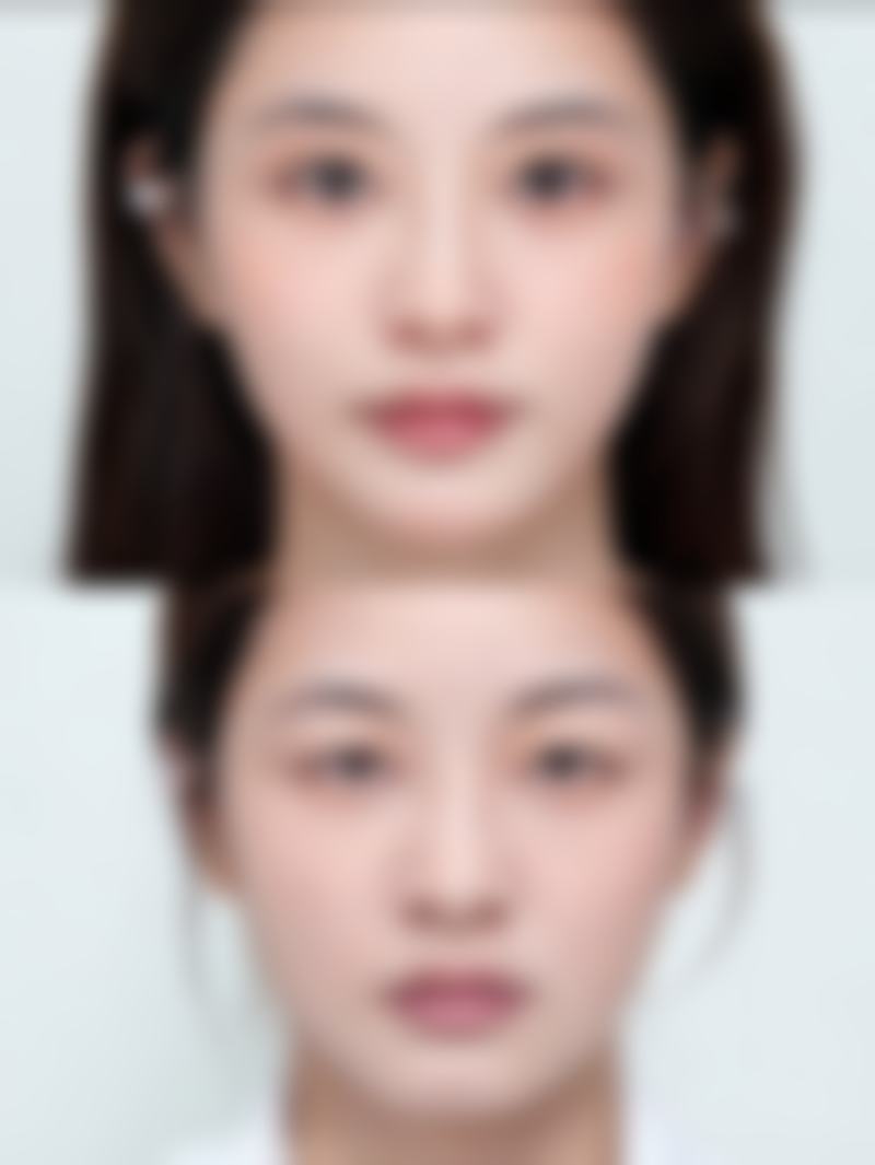 关于包皮手术的常见误区