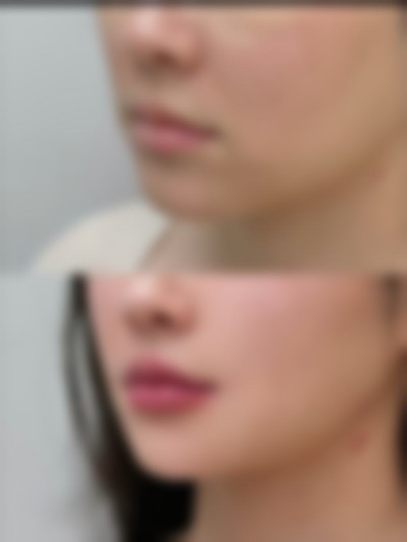 注射除皱好不好