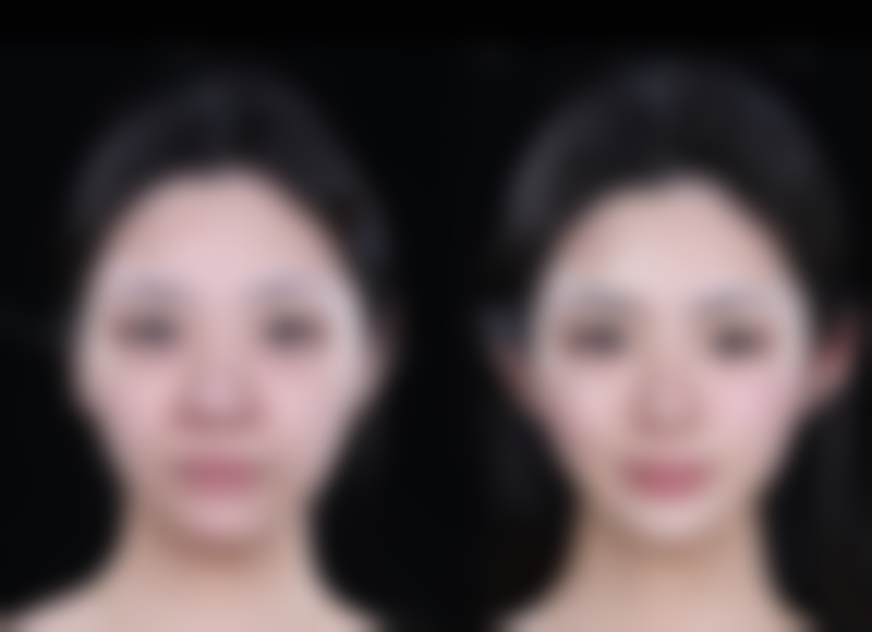 美白针会反黑吗