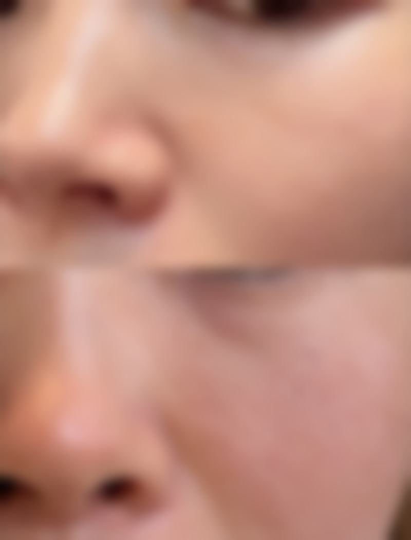 除皱针打一次能维持多久？揭秘一般3 - 6个月效果时长，掌握延长维持时间秘诀让美丽更持久！ 