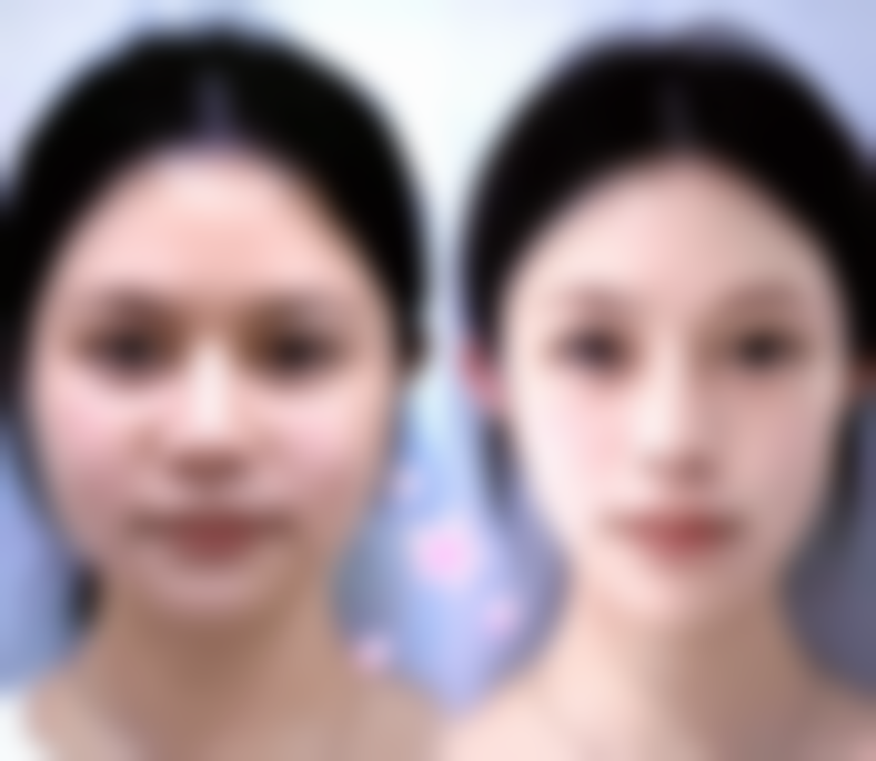 微针去皱技术治疗成效如何