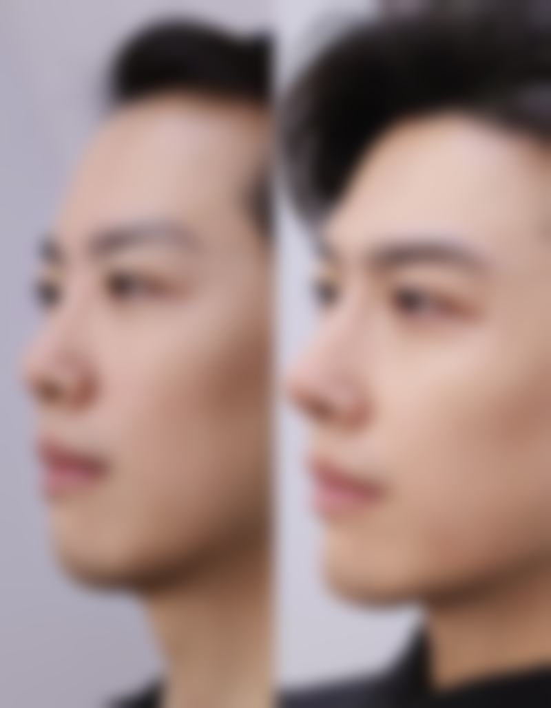 注射除皱针对身体有害吗