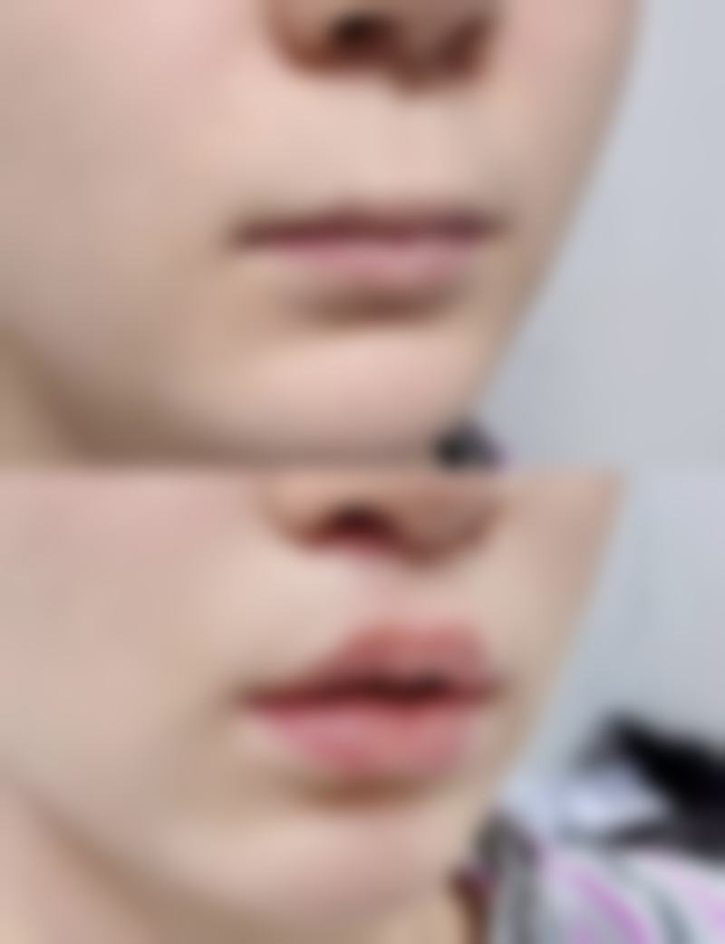 打瘦脸针后饮食注意哪些事项