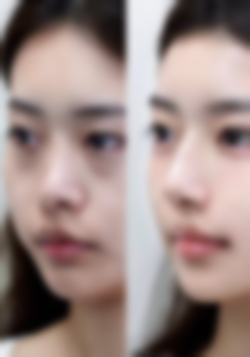 注射除皱针的成效与时间