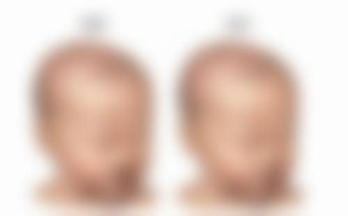 打完瘦脸针多久可以超声 刀