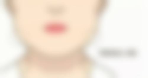 OPT祛疤情况探讨