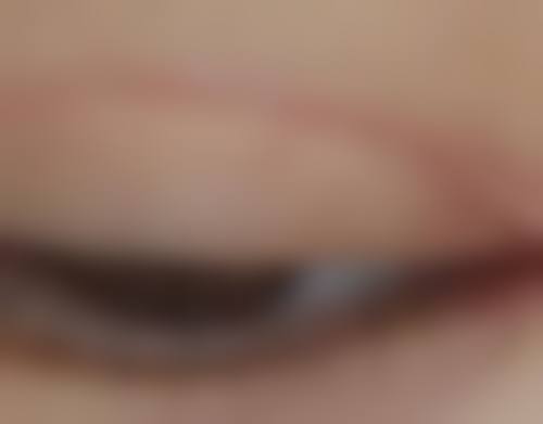 如何降低瘦脸针的风险?