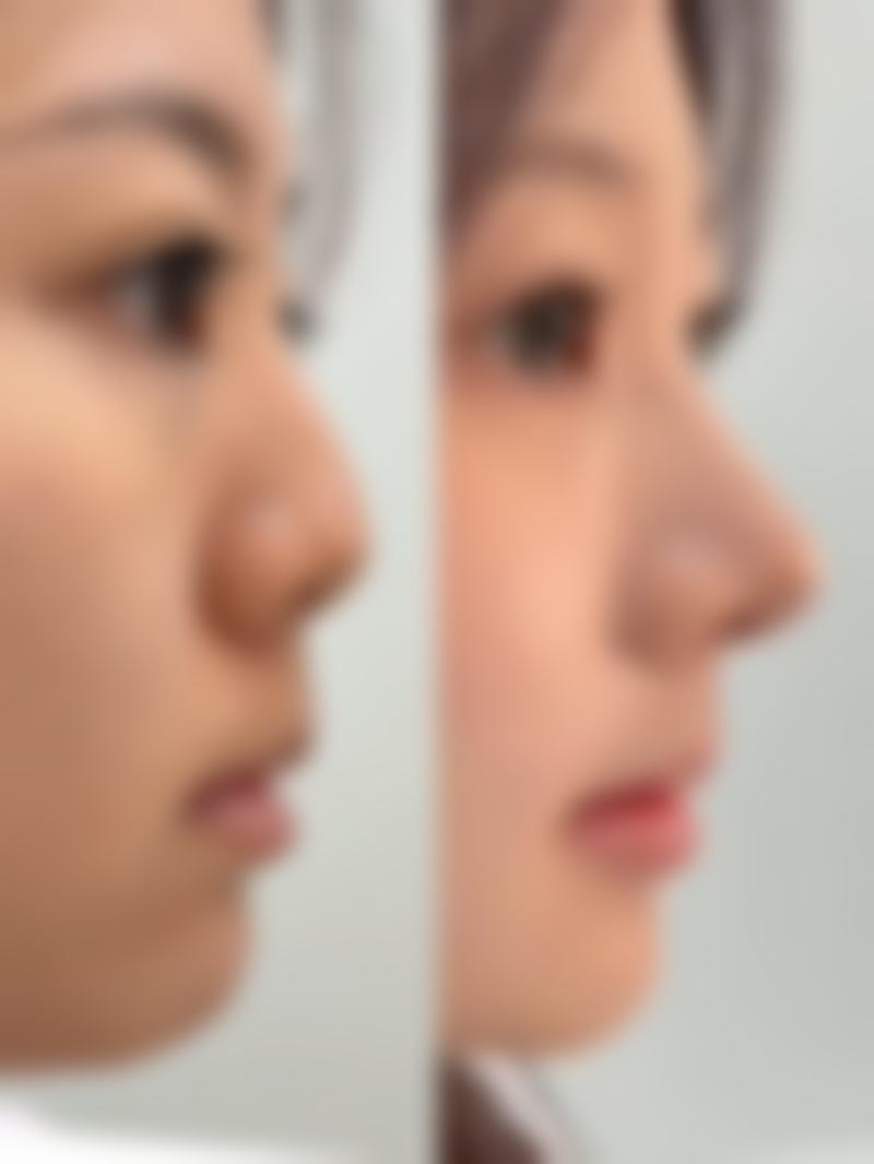 瘦脸针打多了没效果怎么办？了解这 5 大医美补救方法，快速重拾精致小 V 脸！ 