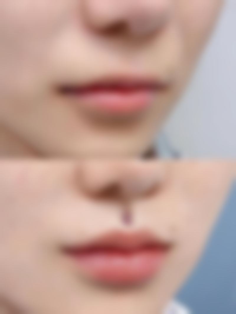 OPT除皱成效探秘