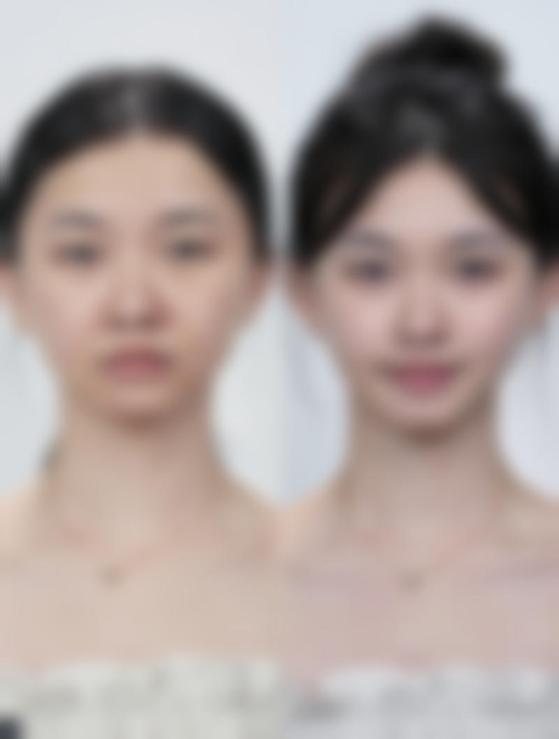 打完瘦脸针注意事项有哪些呢