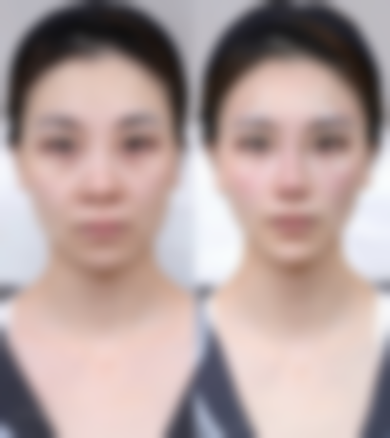 八、美白针连着打还是隔几天？