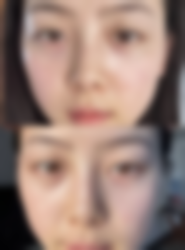 打完瘦脸针正确的睡姿