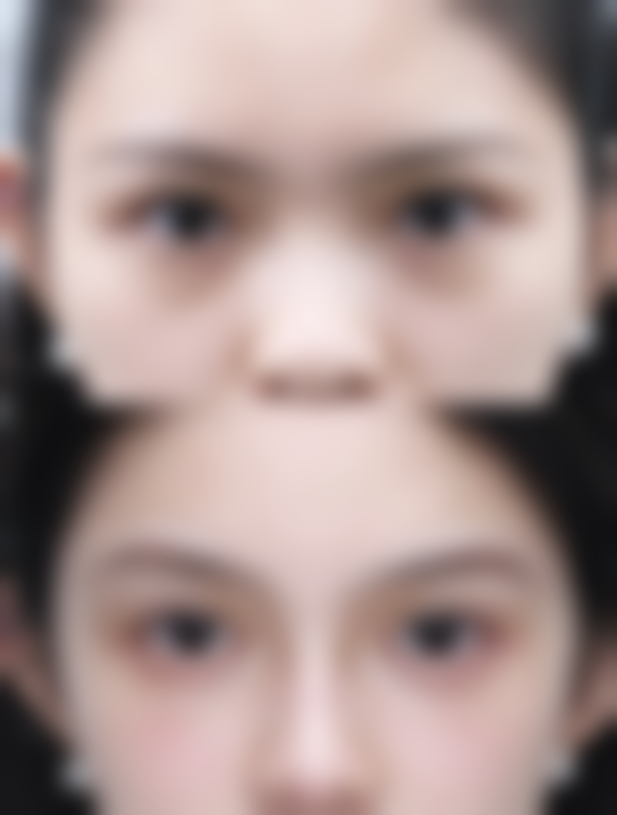 打完瘦脸针 8 天了感觉脸还是肿的