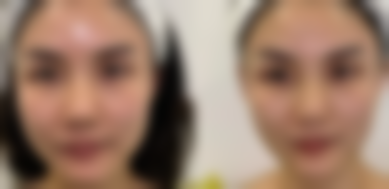 瘦脸针打完多久见效