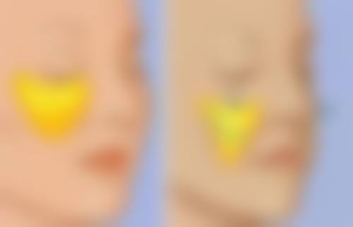 大方脸适合打瘦脸针吗？揭秘3种常见大方脸成因，告诉你打瘦脸针能否实现小V脸奇迹！ 