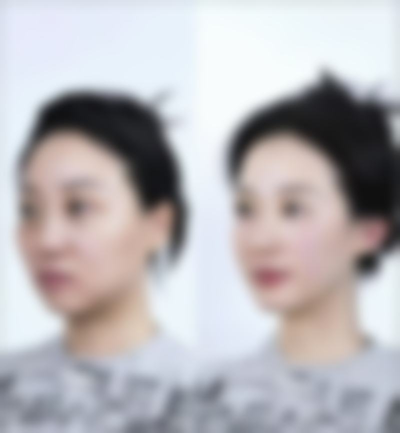 打完瘦脸多久有成效?