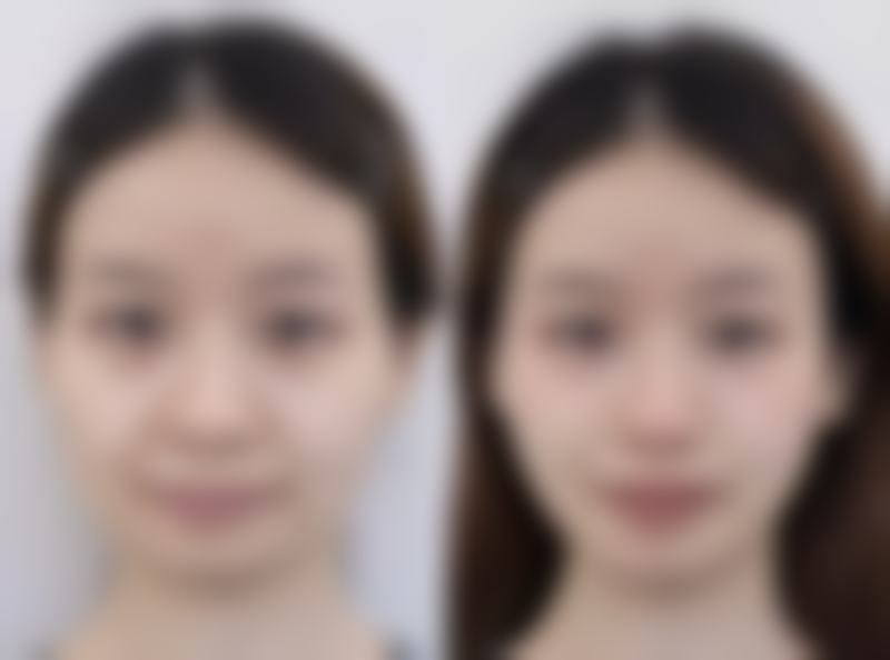 种植发际线多久可以打除皱针