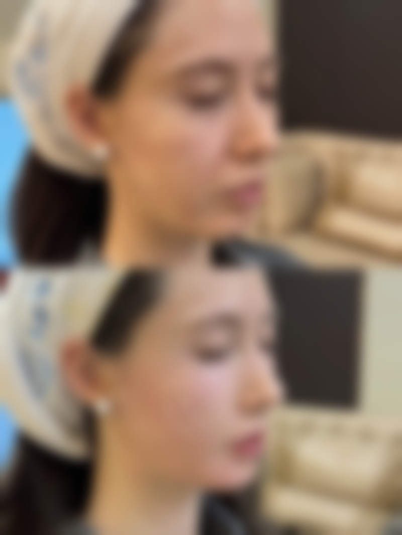 瘦脸针成效太好了