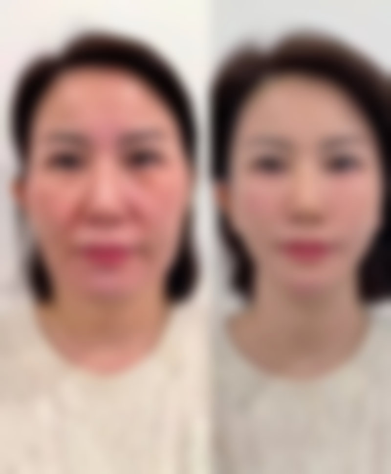 瘦脸针多久见成效明显