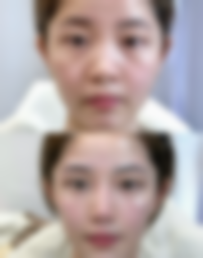 打完瘦脸针正确的睡姿