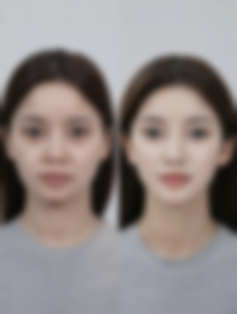 瘦脸针多少钱一次,要打几次定型