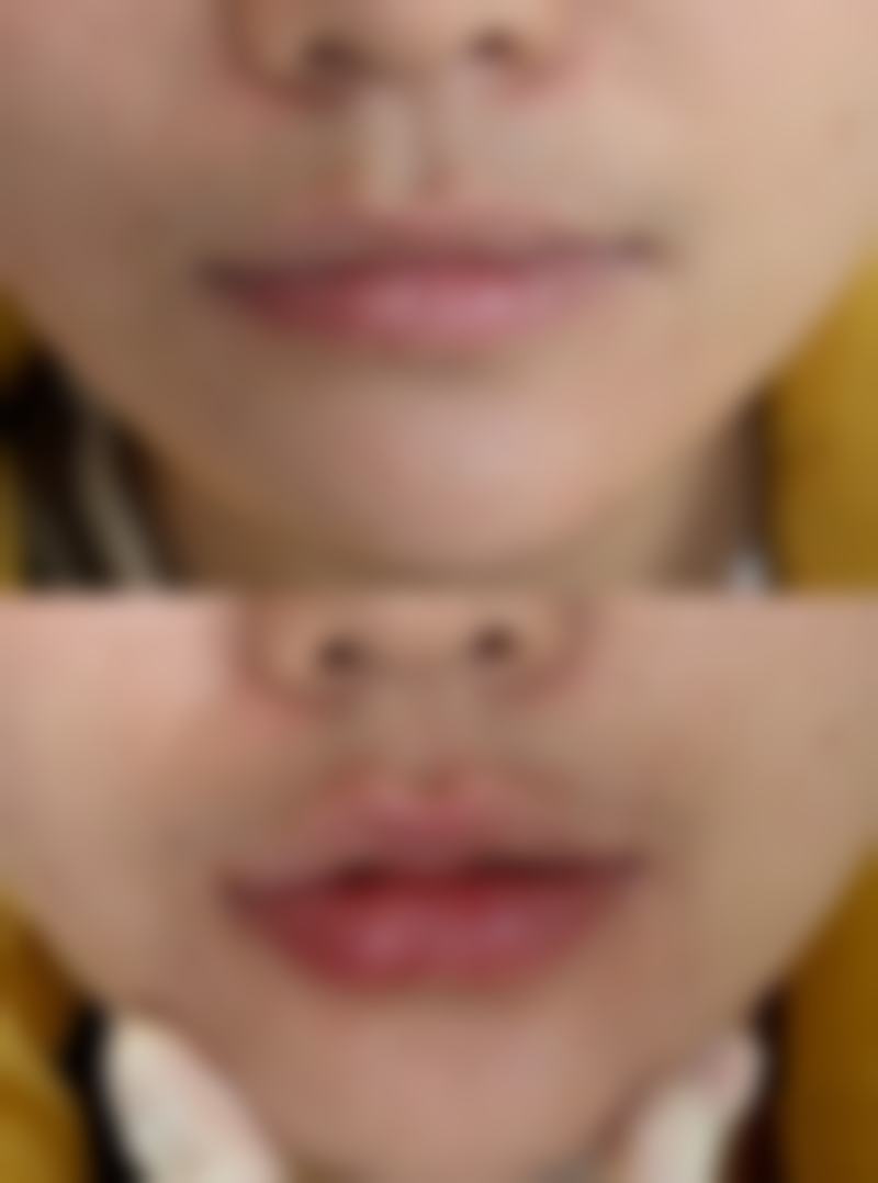 打完除皱针做面部护理有成效吗