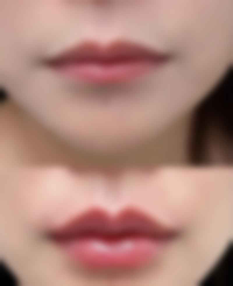 瘦脸针瘦脸成效明显吗