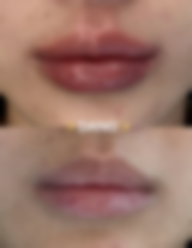 打完瘦脸针注意事项有哪些呢?