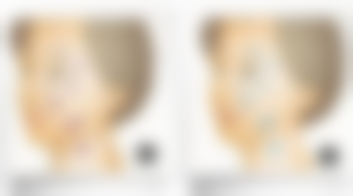 厚唇改薄手术详细介绍