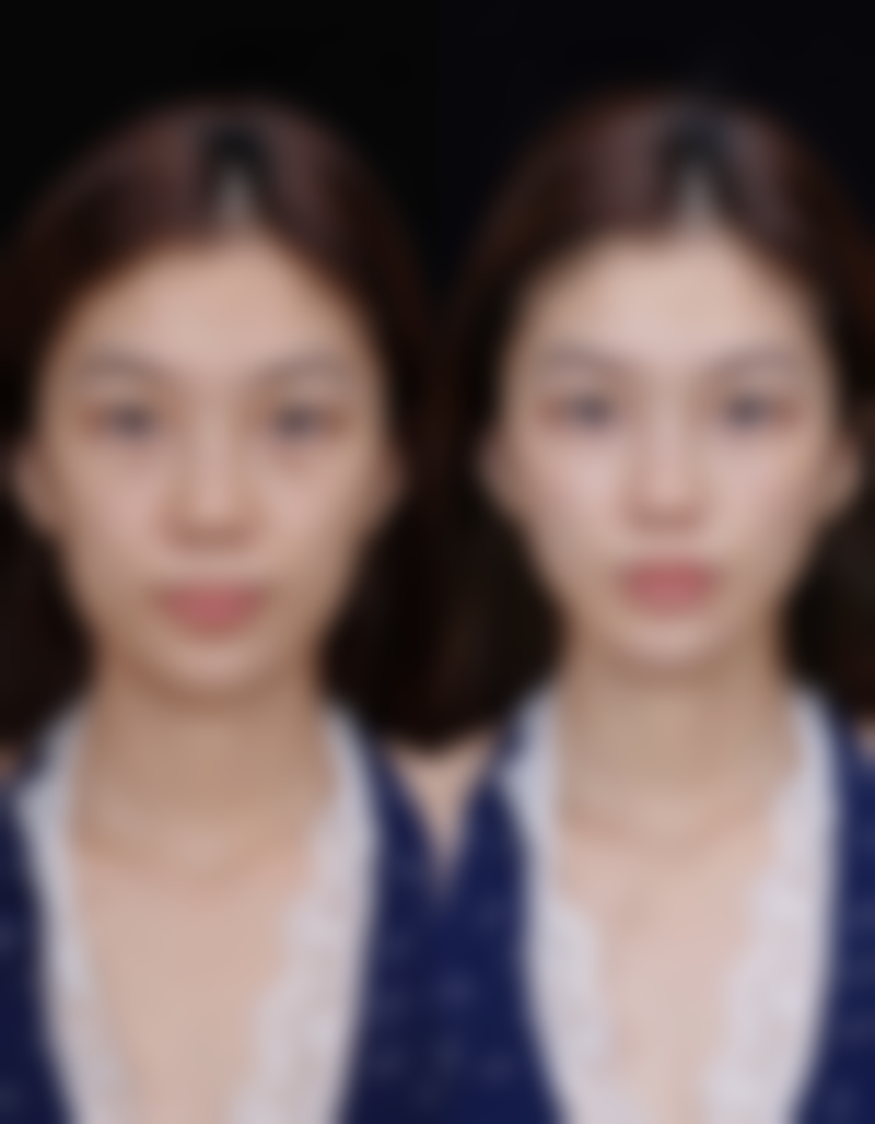 打瘦脸针多长时间可以打第二针？了解间隔时间，掌握正确周期，让你的瘦脸效果更持久！ 