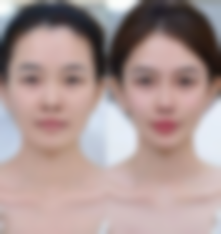 如何降低打除皱针的风险