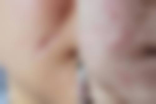 青岛瑧妍美医疗美容医院金哲做除皱抗衰技术值不值?