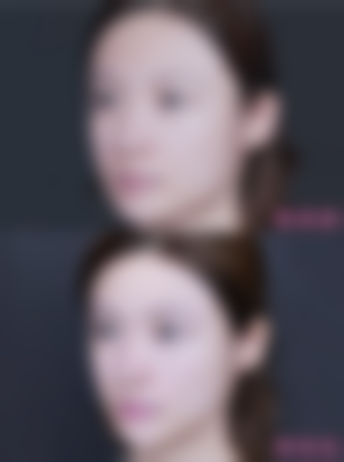 北京米兰柏羽丽都医美乔雅登雅致玻尿酸除皱项目的技术优势