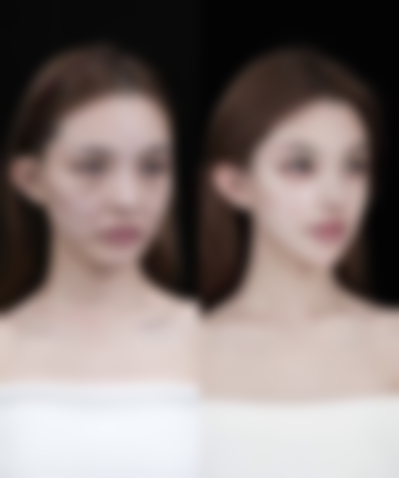 瘦脸针注射多少个单位