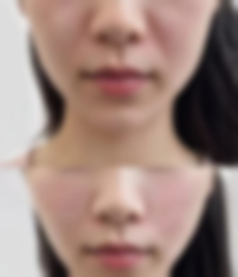 毛发种植成效怎么样？