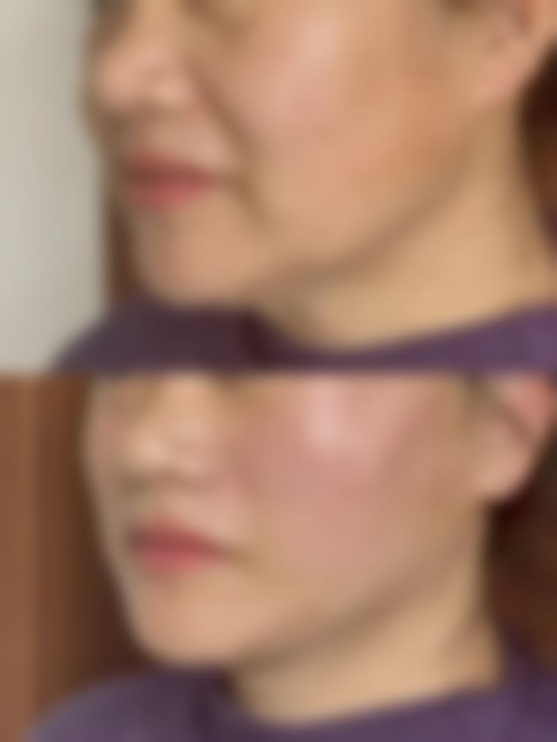 种植头发真的可以自然生长吗