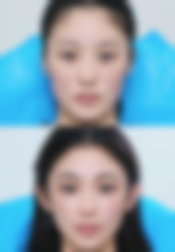 二、除皱针对身体是否有伤害