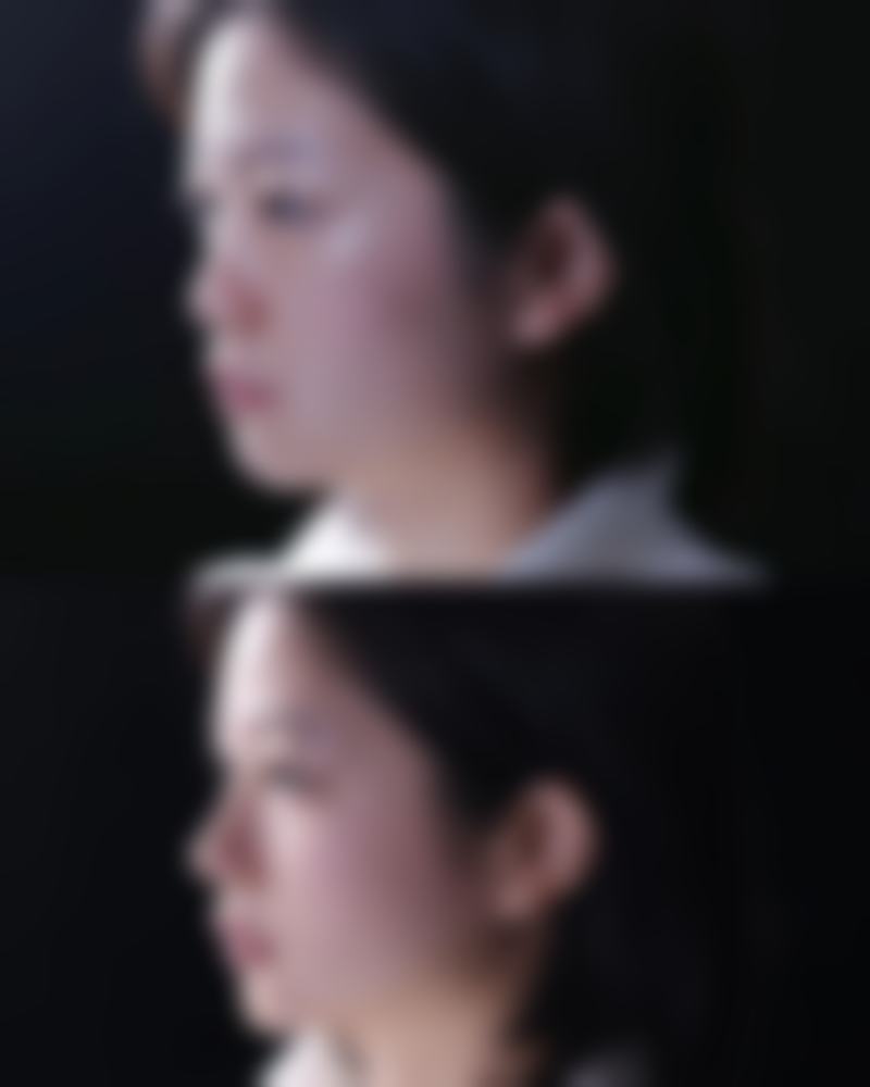 种植发际线能保持多少年