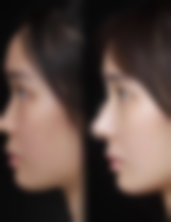 种植发际线需要多少钱