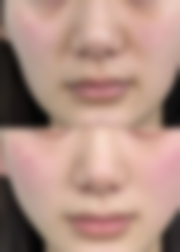 九、除皱针一年打几次更好