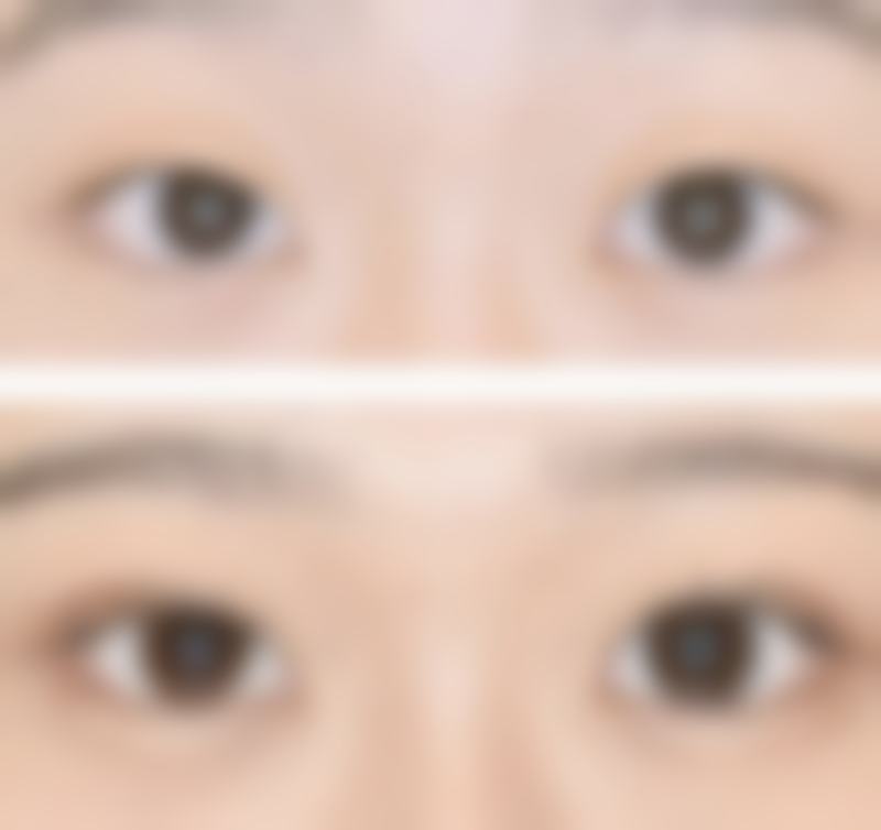 激光阴道紧缩术有成效吗