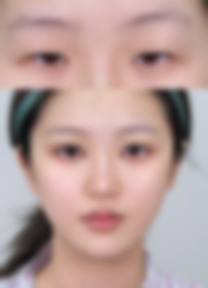 种植发际线1000单位的成效