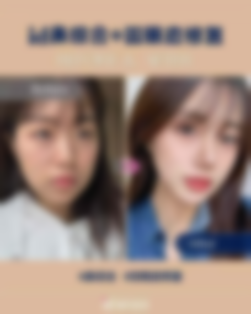 毛发种植术价格