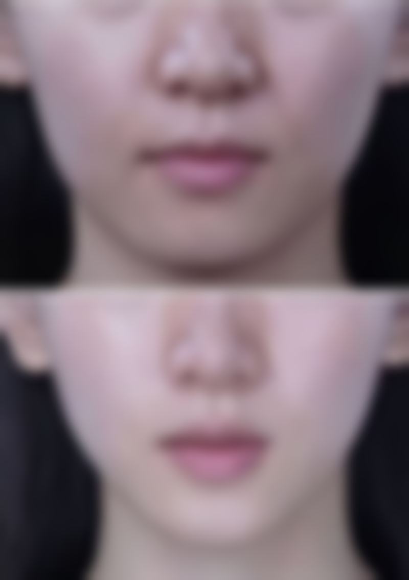 毛发种植术费用