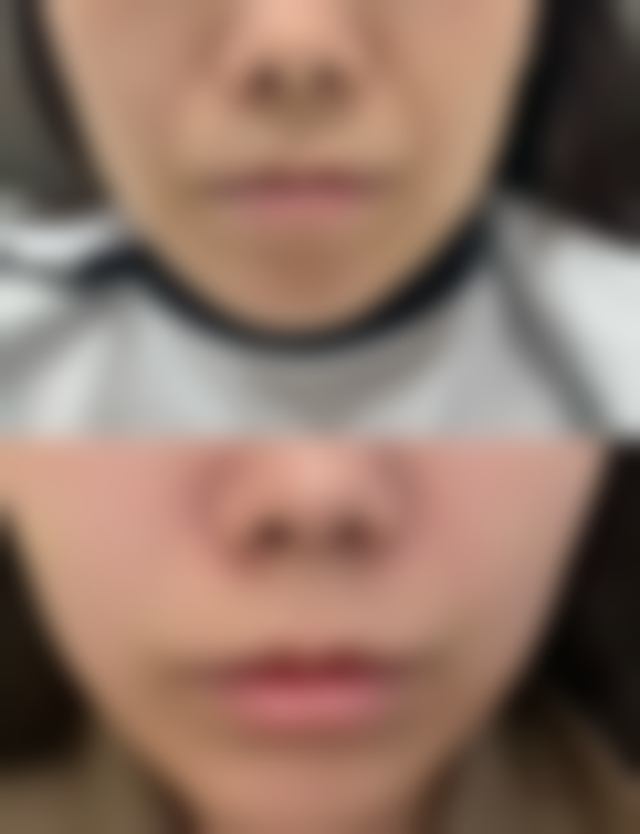 嘴巴偏斜的预防措施